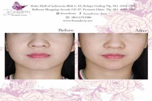 Chin Augmentation / Filler Dagu